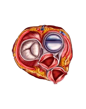 Human Heart Prosthetics